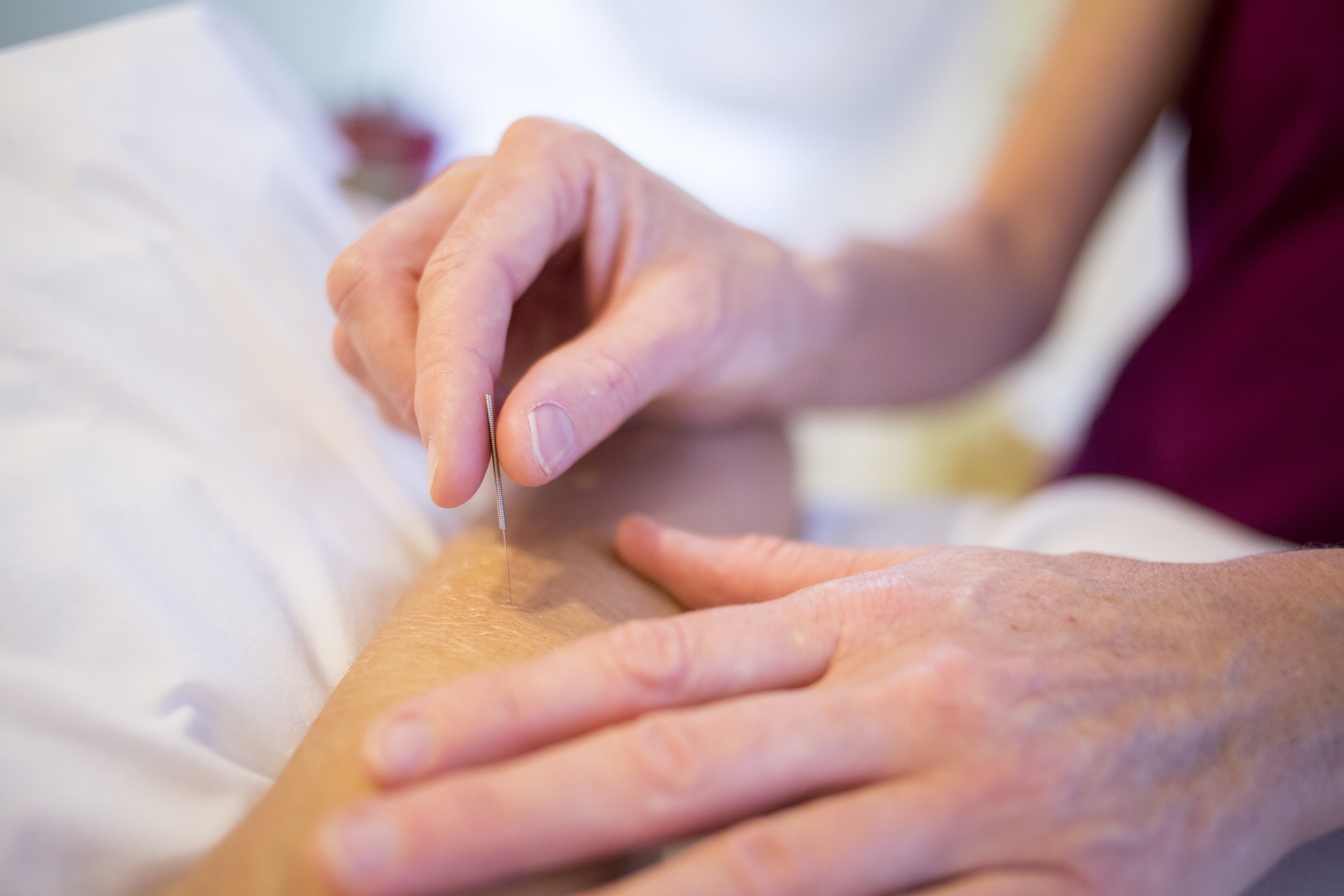 Best Acupuncture in Frisco TX